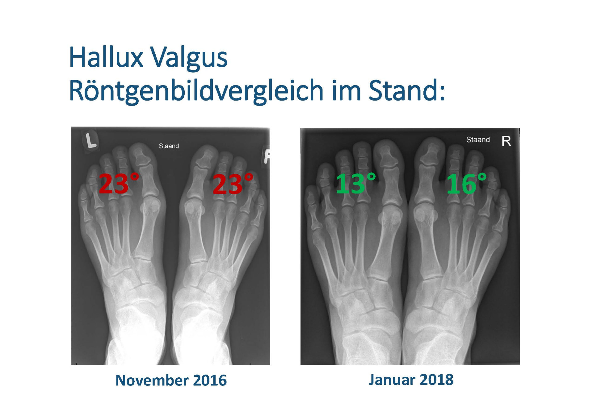 Röntgenbildvergleich im Stand einer Kundin mit Hallux valgus: November 2016 (23° beidseits) und Januar 2018 (13° und 16°)