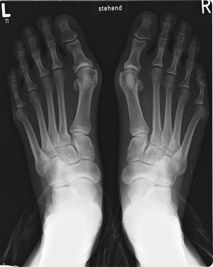 Hallux valgus – Die "Volkszehen - Fehlstellung"