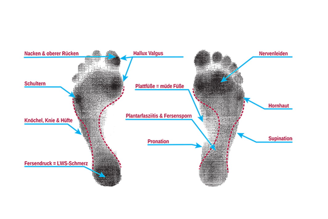 Fußabdruck-Karte mit Beschriftungen zu Beschwerden wie Hallux Valgus, Fersensporn und Plattfuß