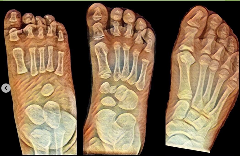 Von 22 über 45 nach 26 oder vom Plattfuß in die Physiologie